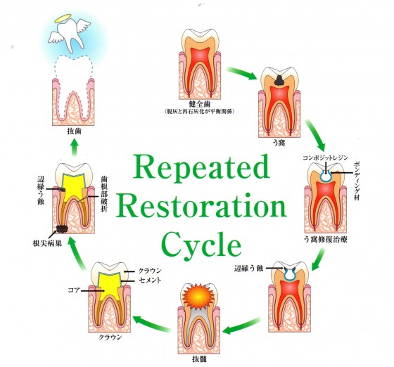 歯を失う負のサイクルの図